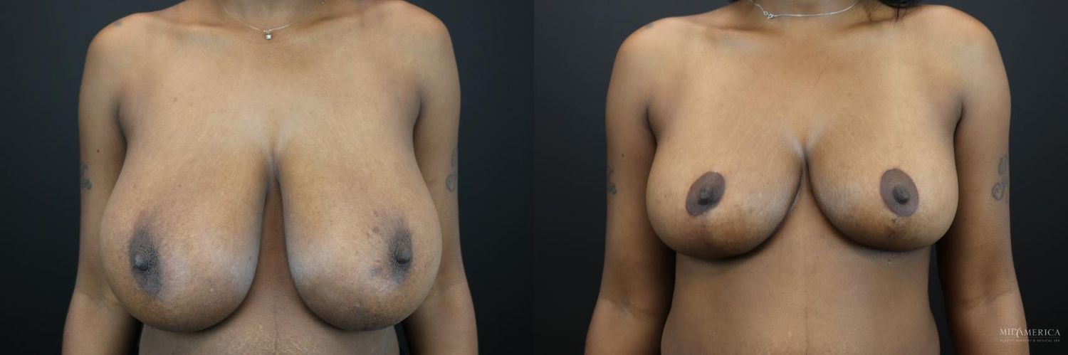 Breast Reduction Before & After