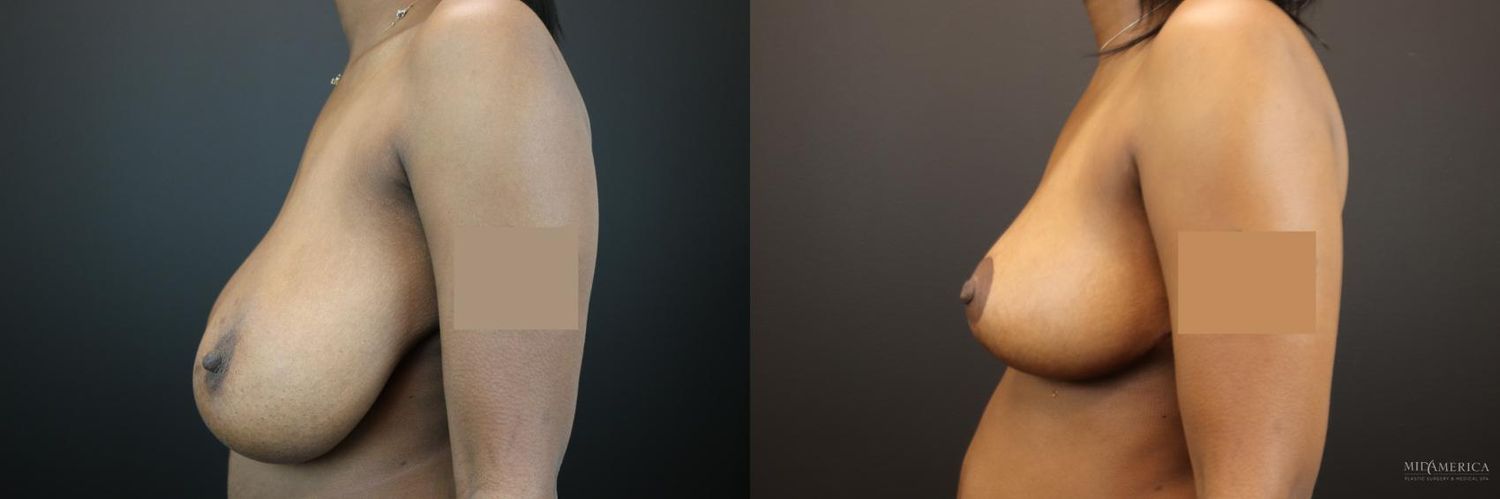 Breast Reduction Before & After