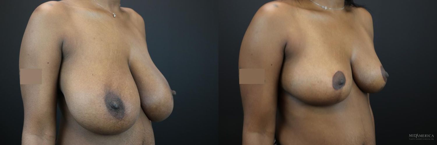 Breast Reduction Before & After