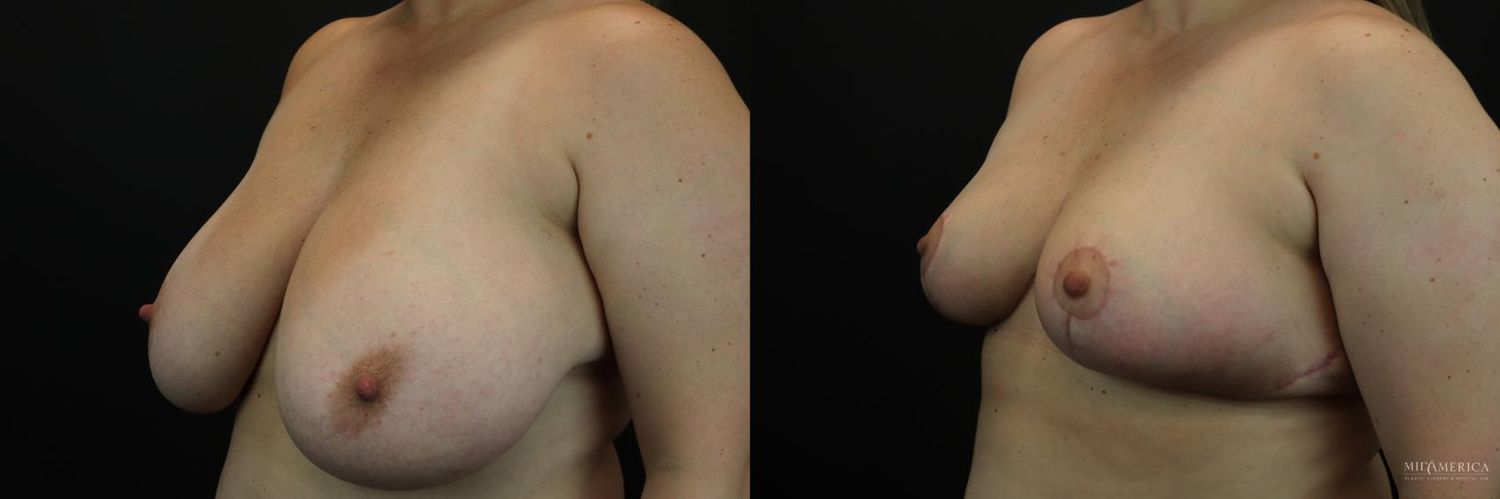 Breast Reduction Before & After