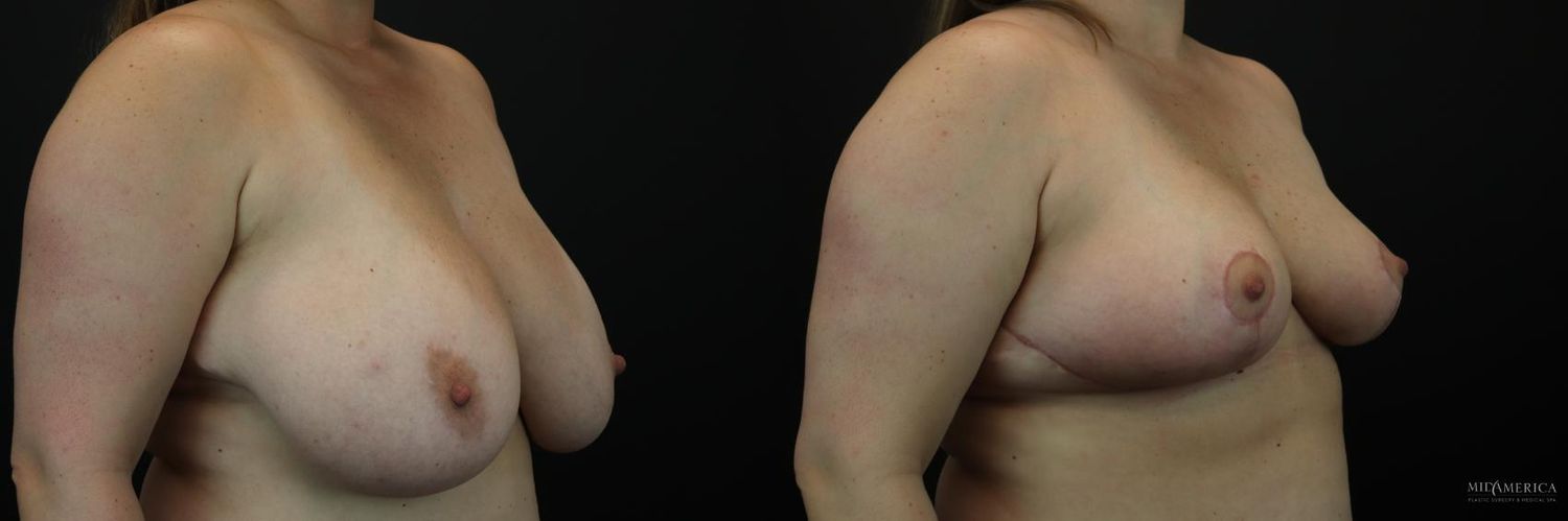 Breast Reduction Before & After