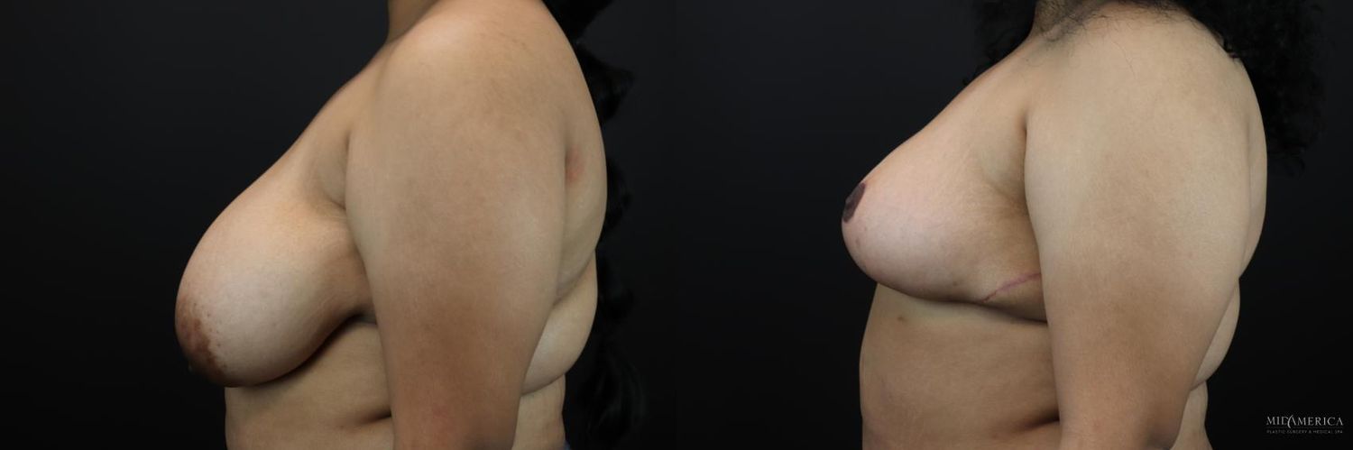 Breast Reduction Before & After