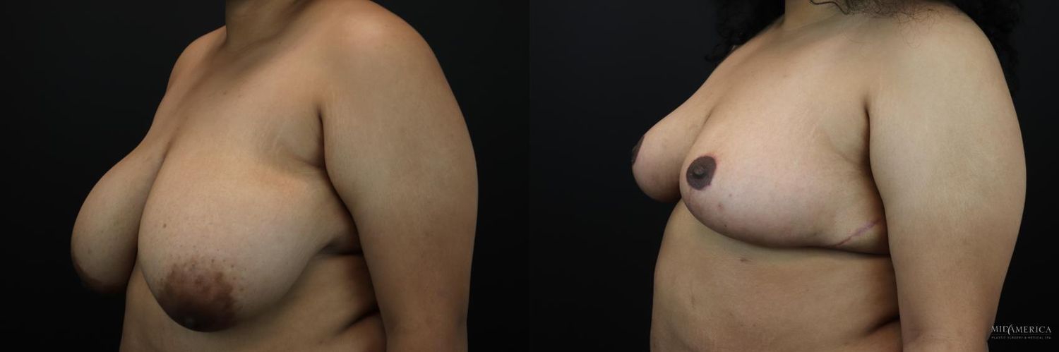 Breast Reduction Before & After
