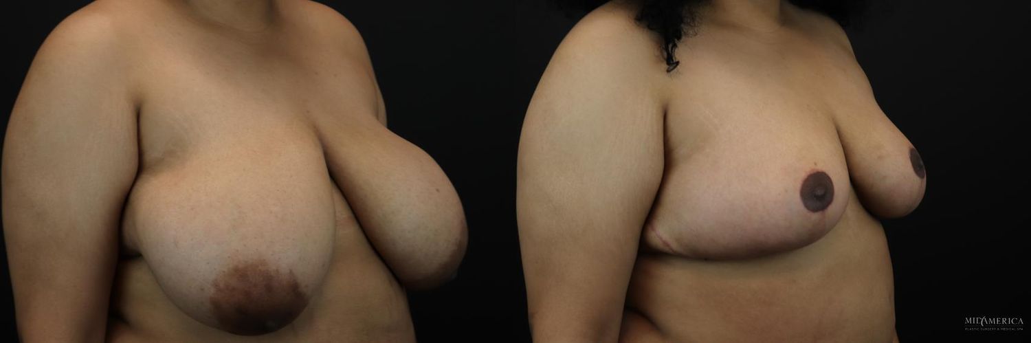 Breast Reduction Before & After