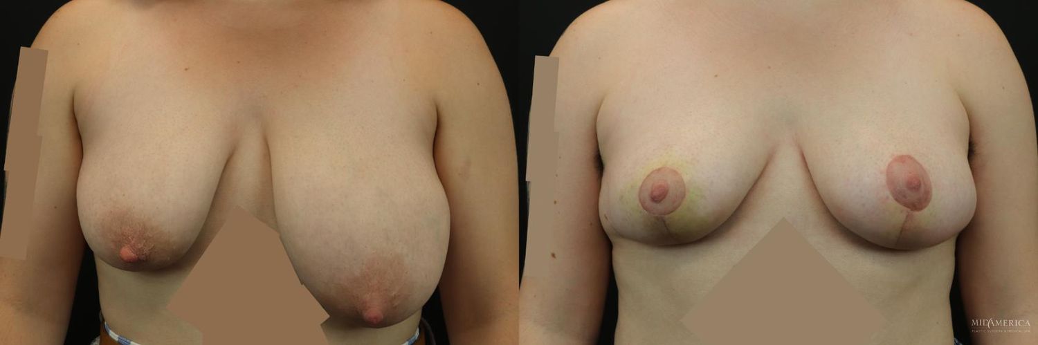 Breast Reduction Before & After