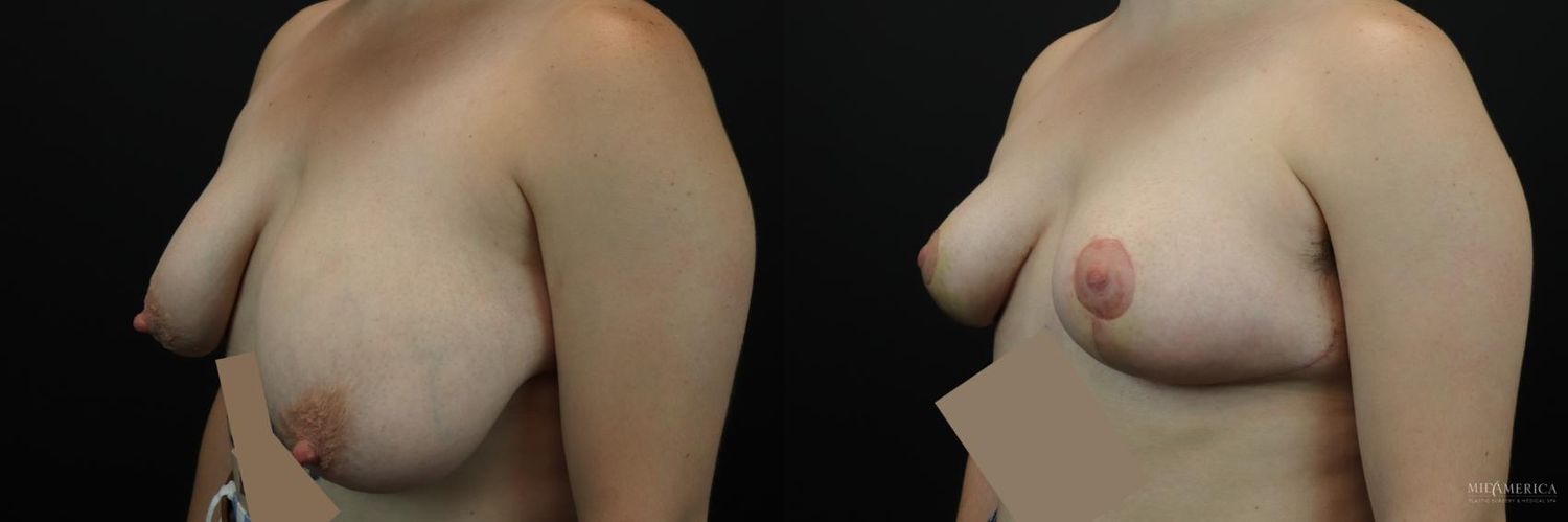 Breast Reduction Before & After