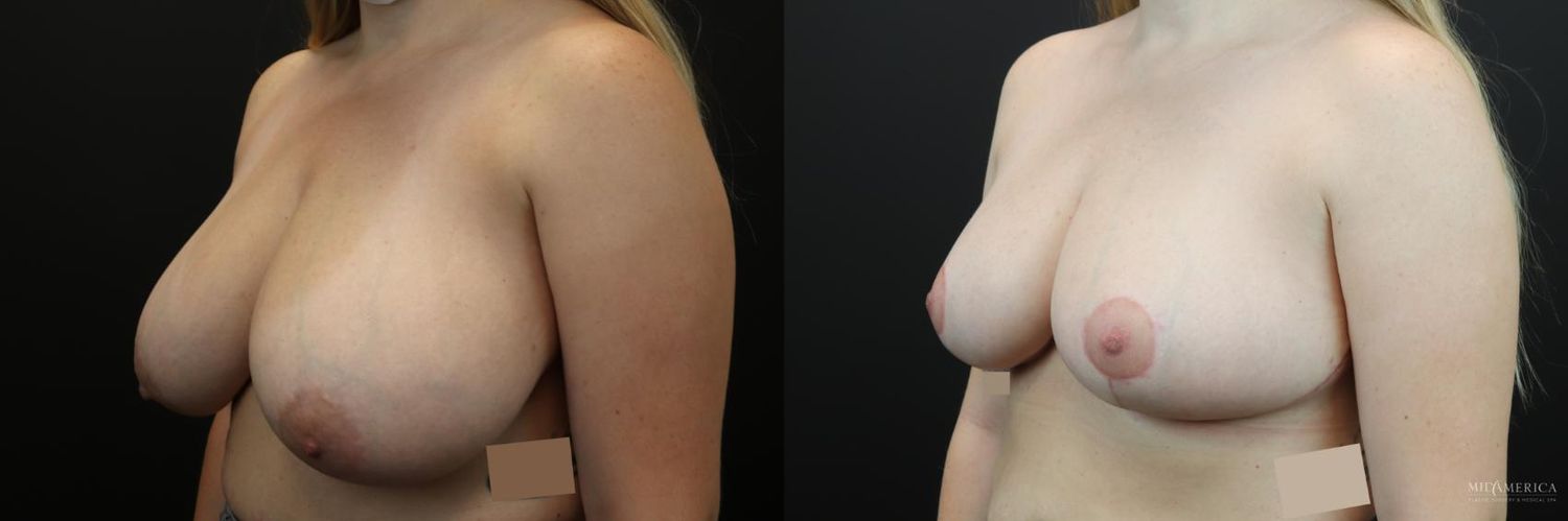 Breast Reduction Before & After
