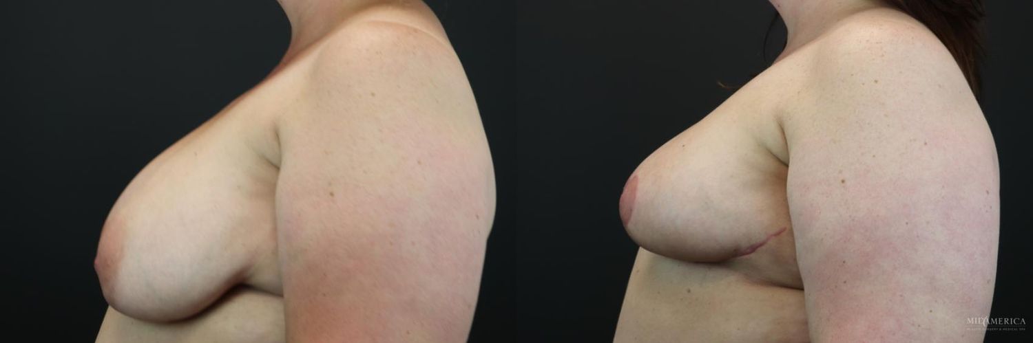 Breast Reduction Before & After