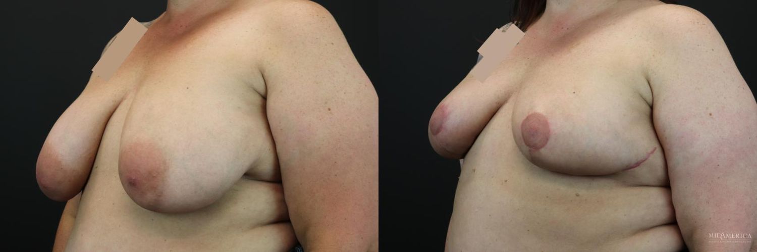 Breast Reduction Before & After