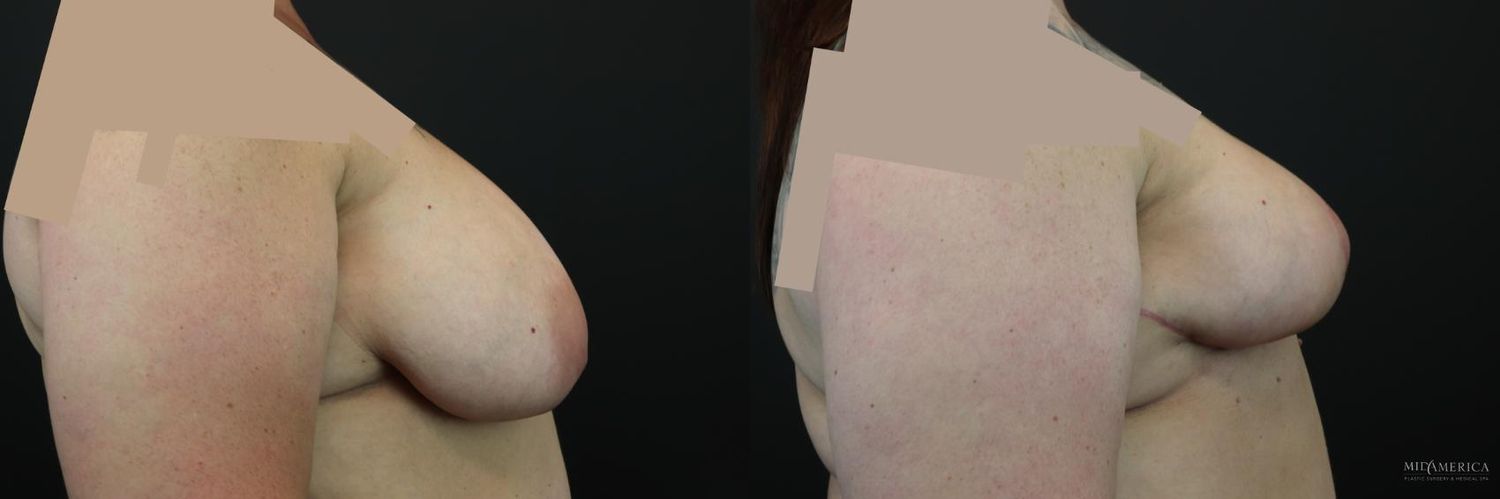 Breast Reduction Before & After