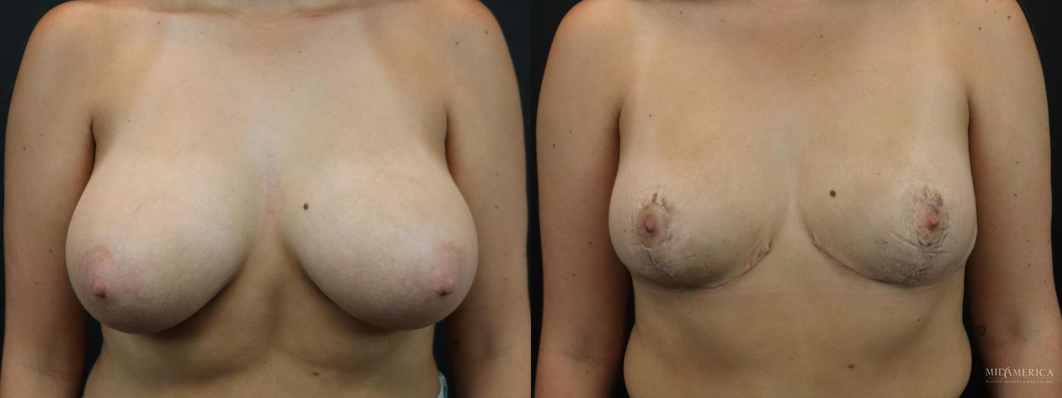 Breast Reduction Before & After