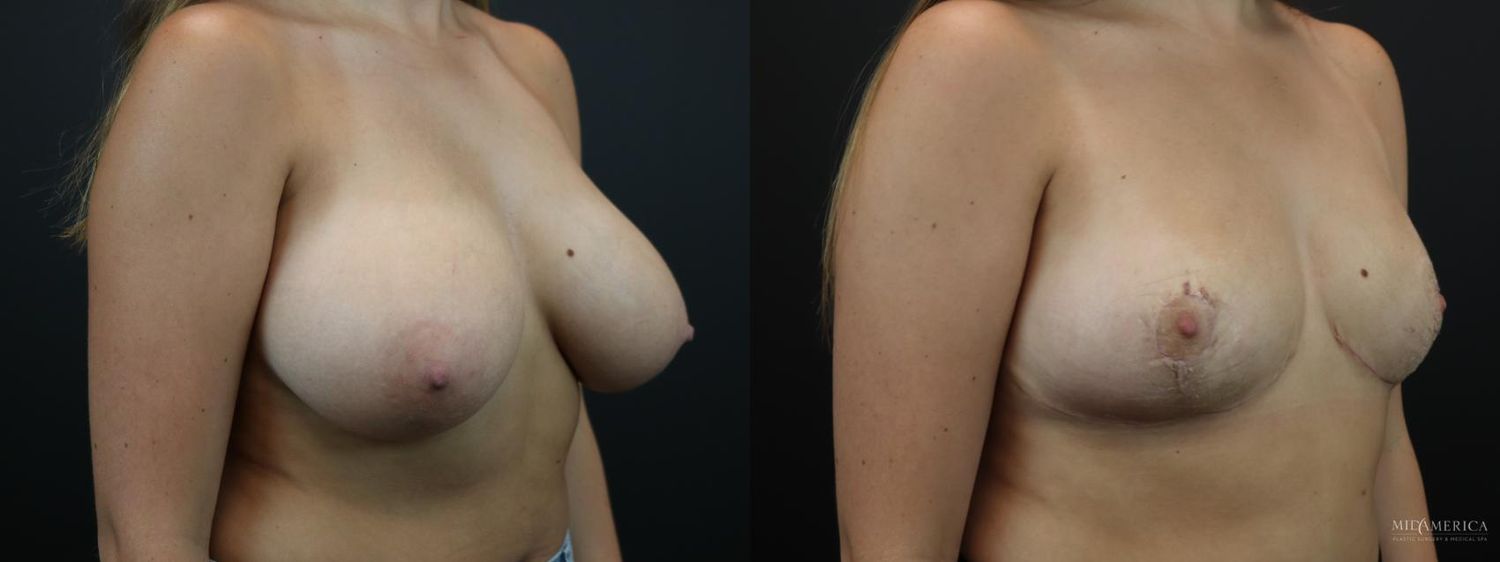 Breast Reduction Before & After