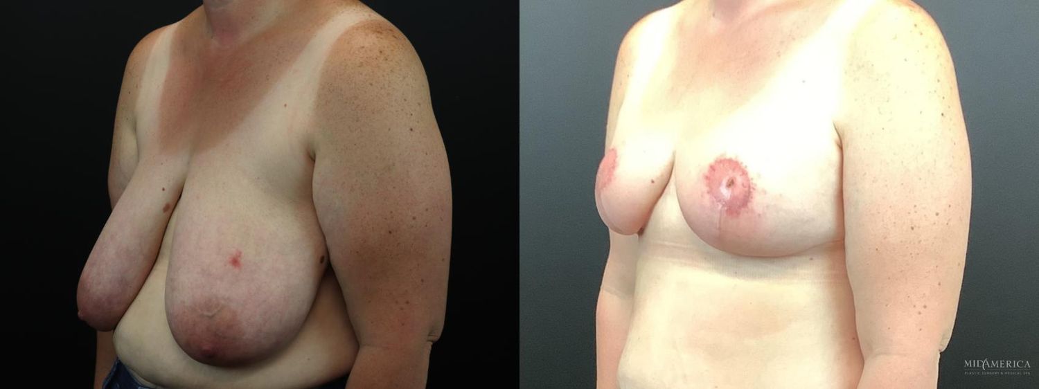 Breast Reduction Before & After