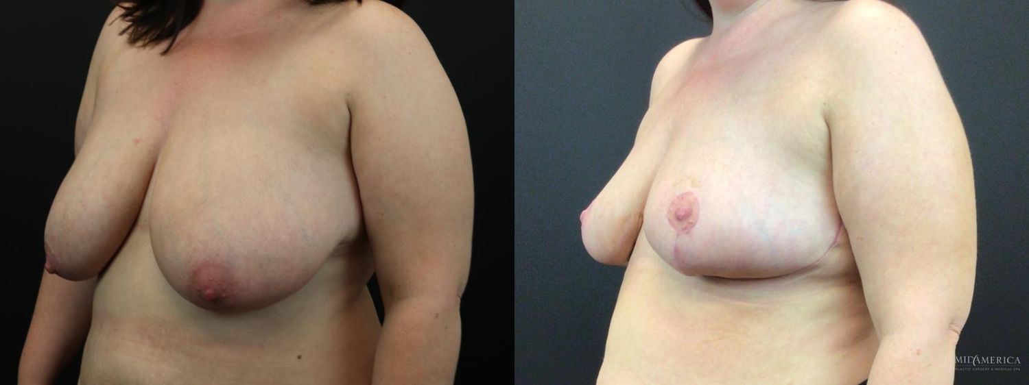Breast Reduction Before & After