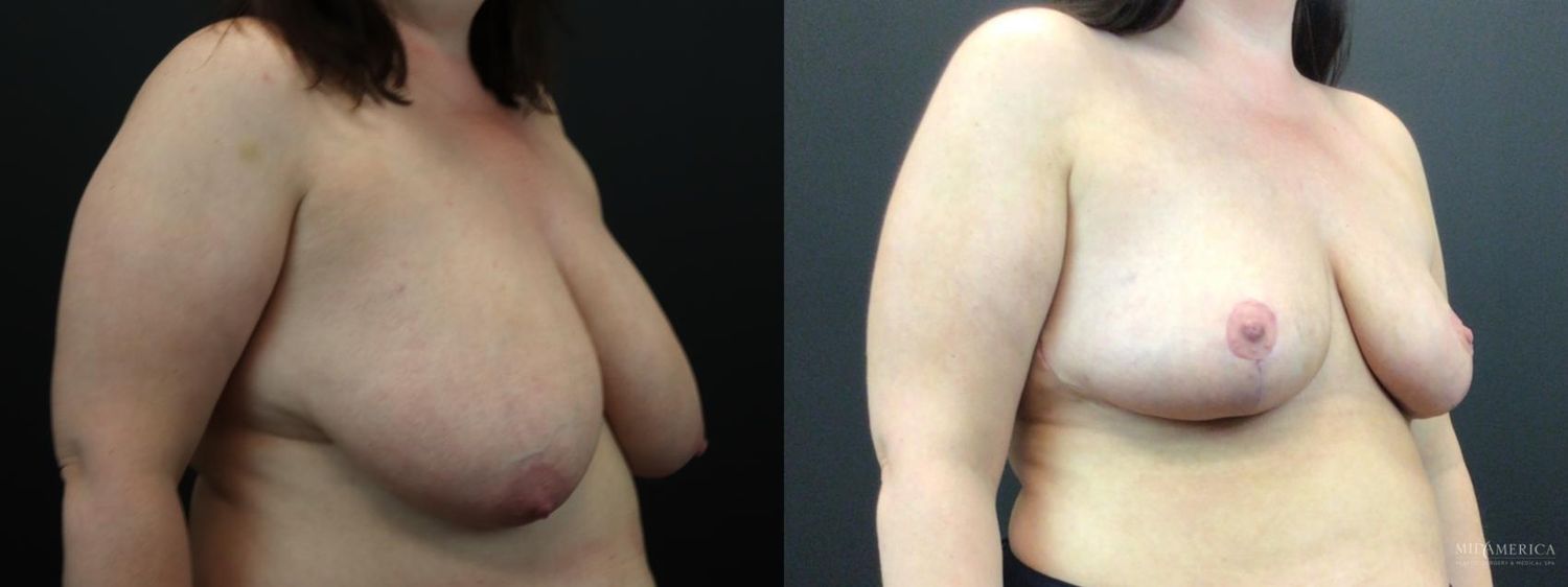 Breast Reduction Before & After