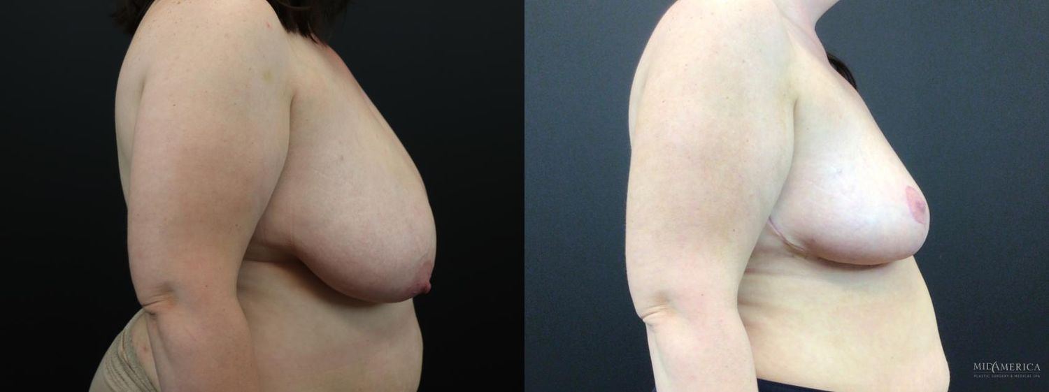 Breast Reduction Before & After