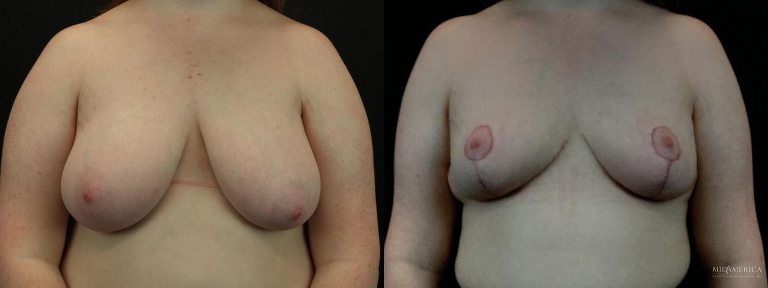 Breast Reduction Before & After
