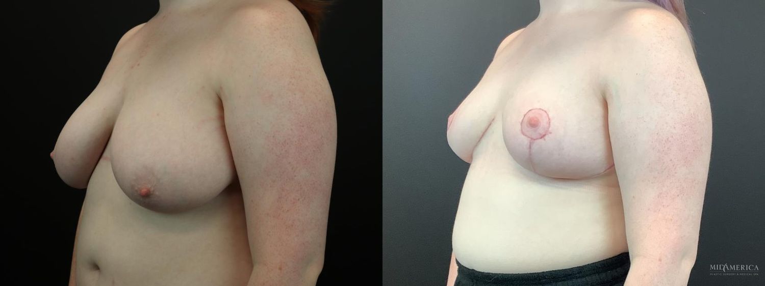 Breast Reduction Before & After