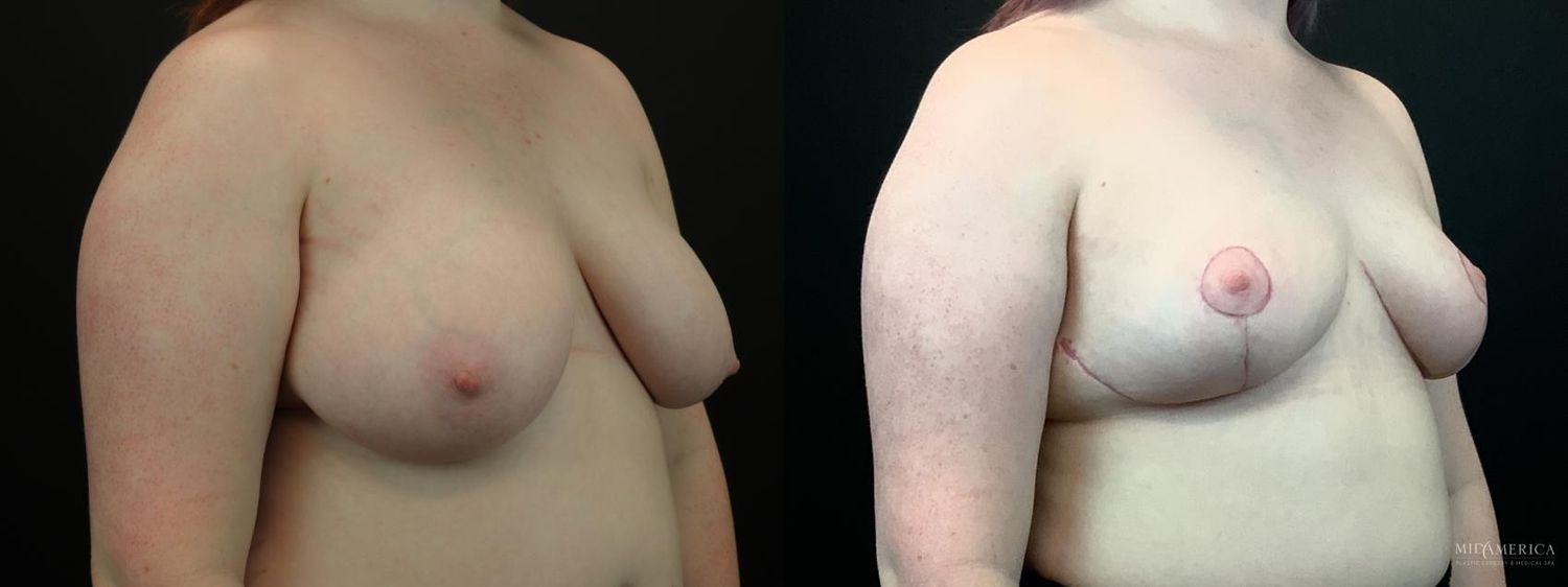Breast Reduction Before & After