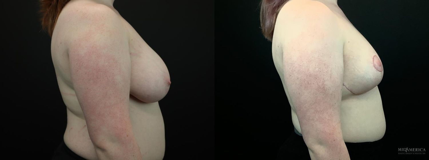 Breast Reduction Before & After