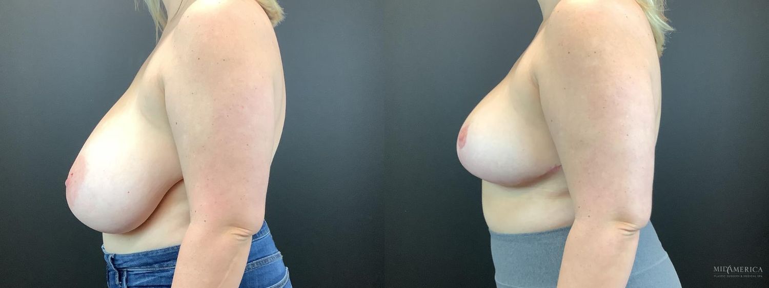 Breast Reduction Before & After