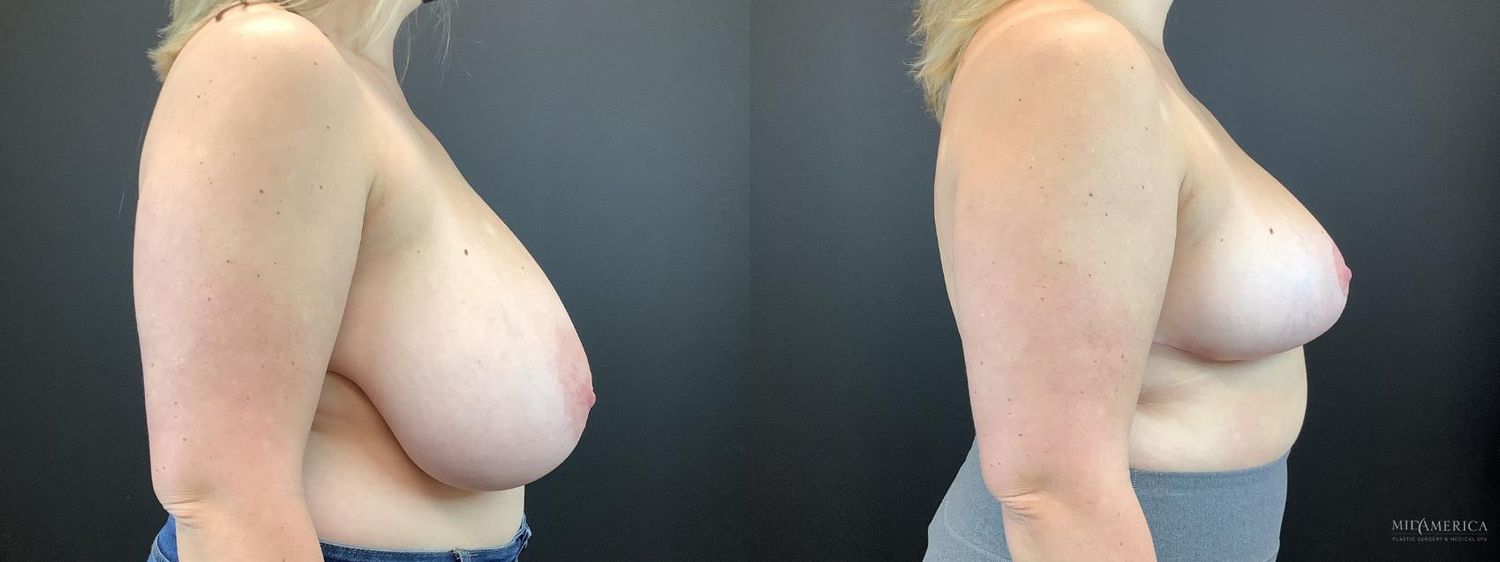 Breast Reduction Before & After
