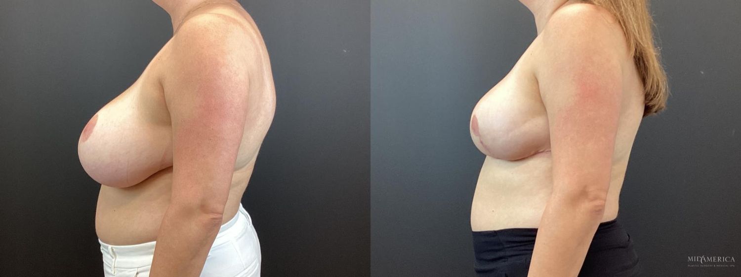 Breast Reduction Before & After