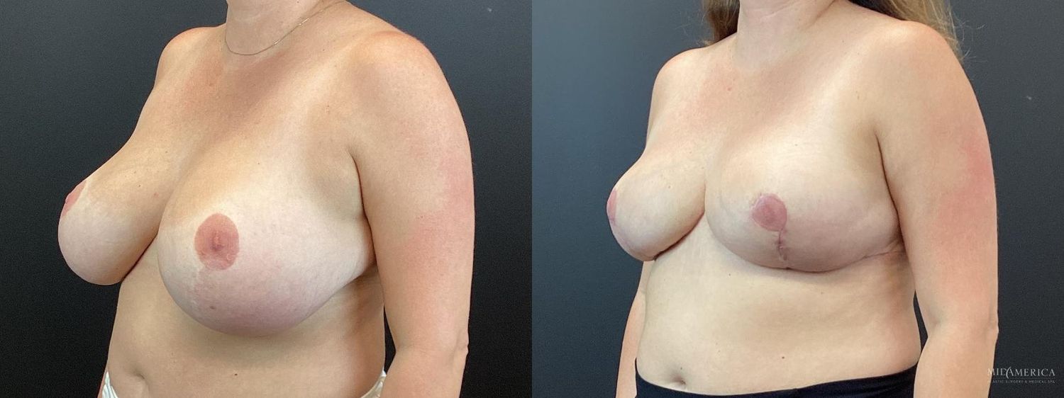 Breast Reduction Before & After