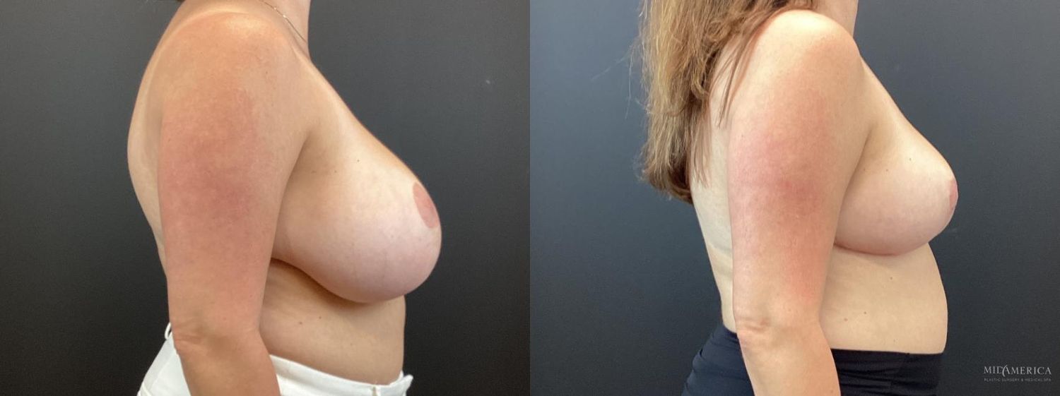 Breast Reduction Before & After