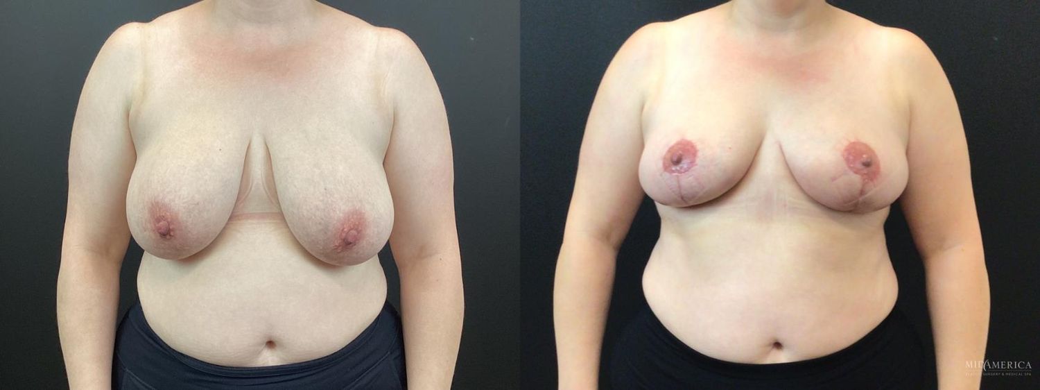 Breast Reduction Before & After