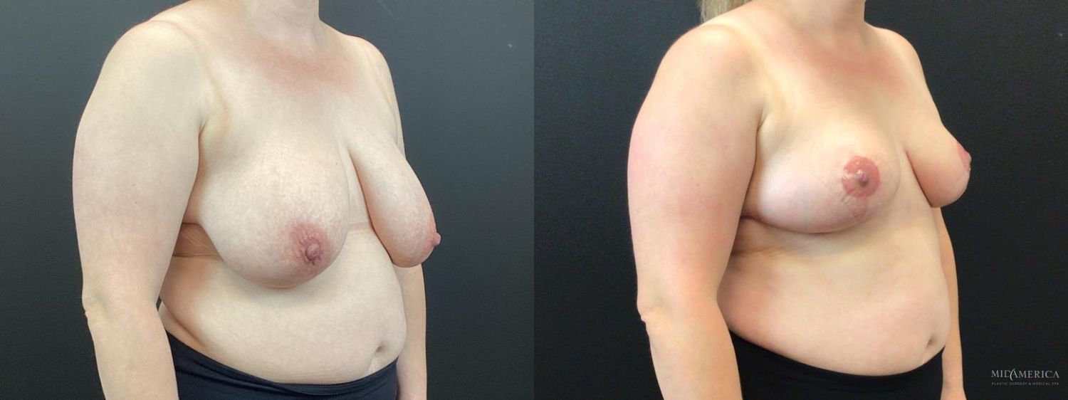 Breast Reduction Before & After