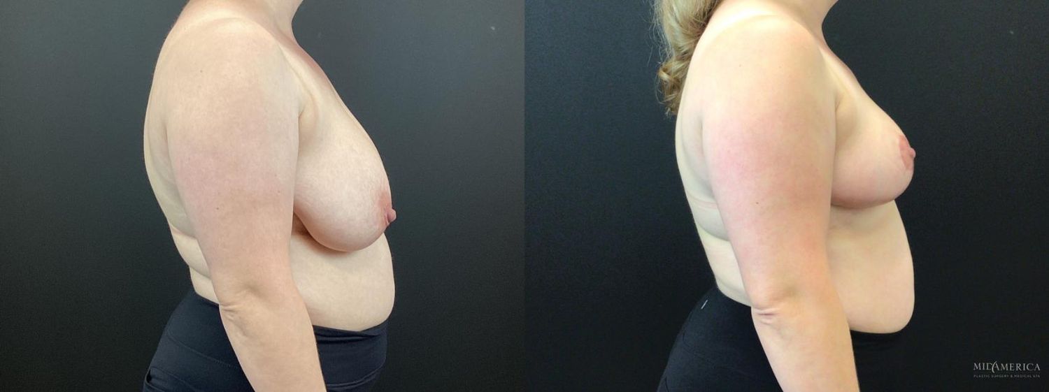 Breast Reduction Before & After