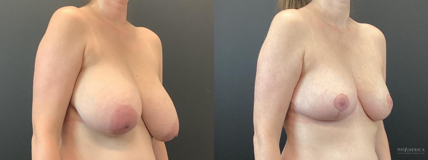 Breast Reduction Before & After