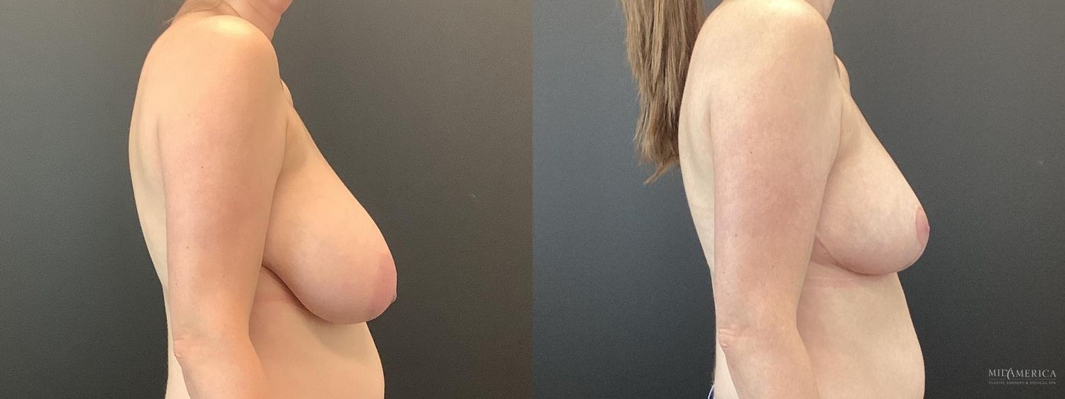 Breast Reduction Before & After