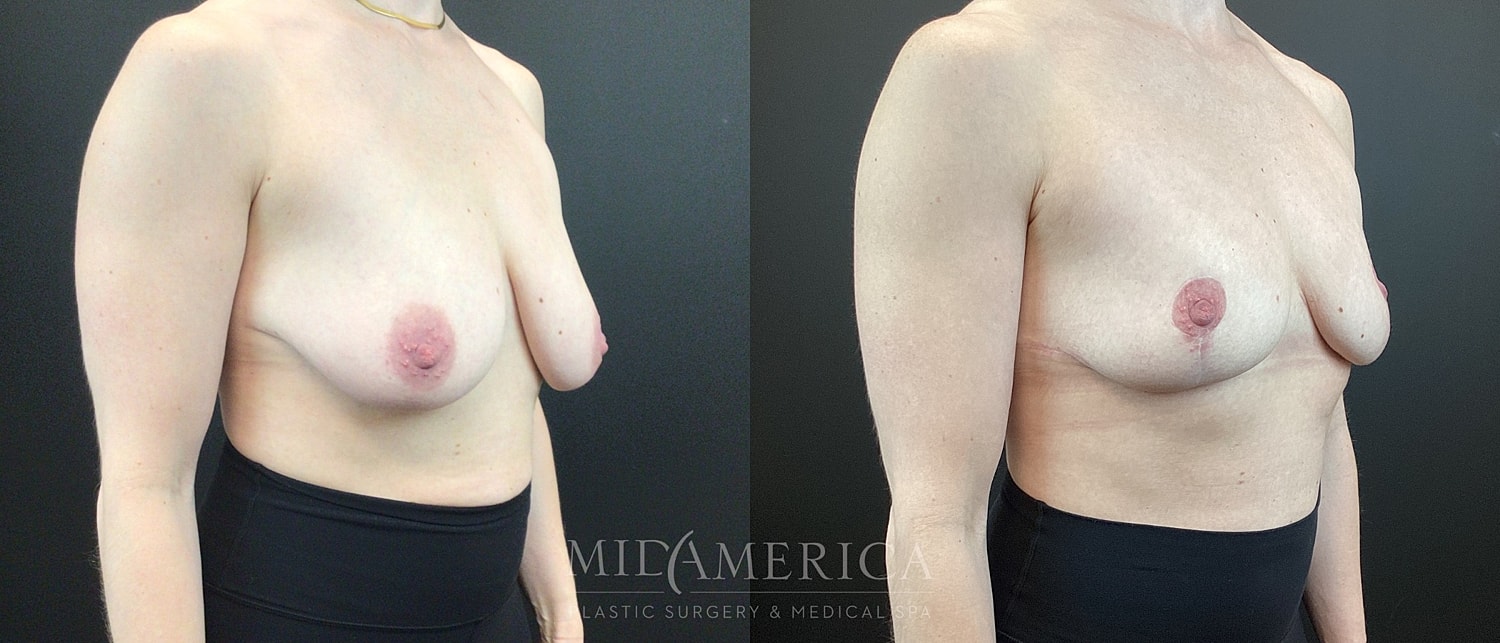 Breast Reduction Before & After