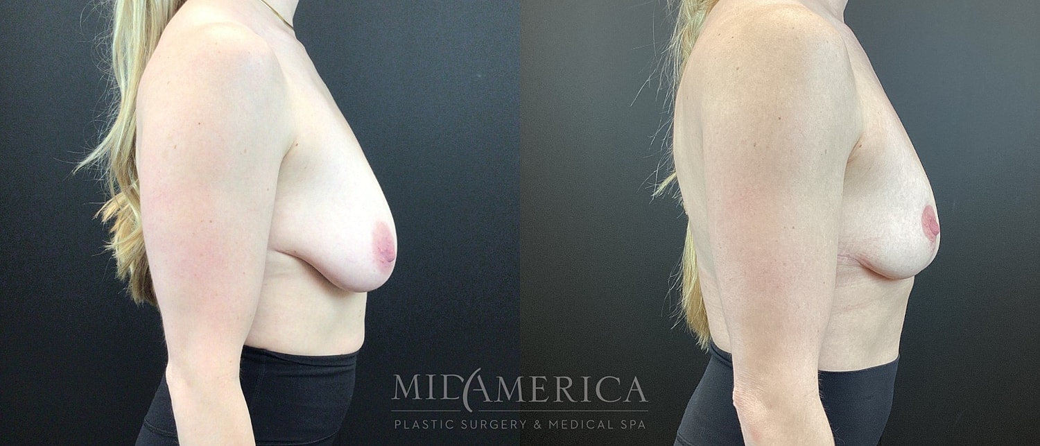 Breast Reduction Before & After