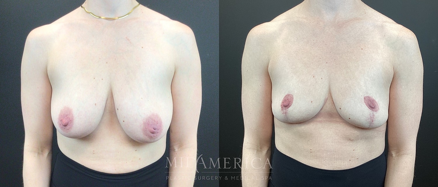 Breast Reduction Before & After