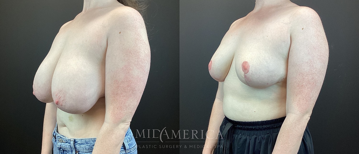 Breast Reduction Before & After