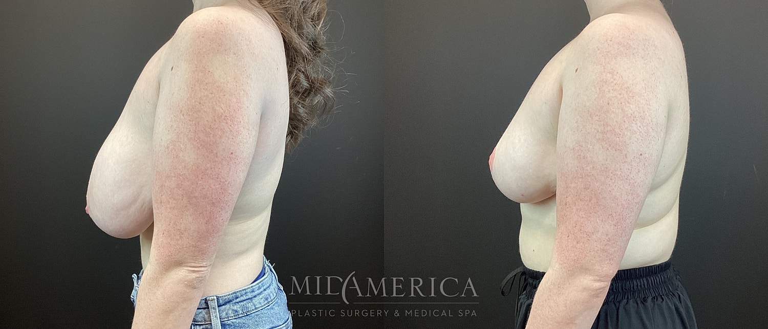 Breast Reduction Before & After