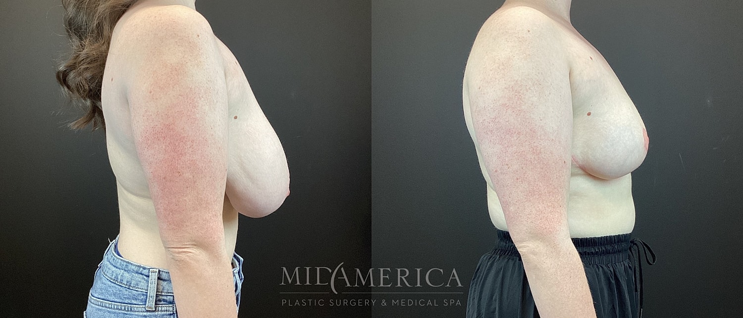 Breast Reduction Before & After