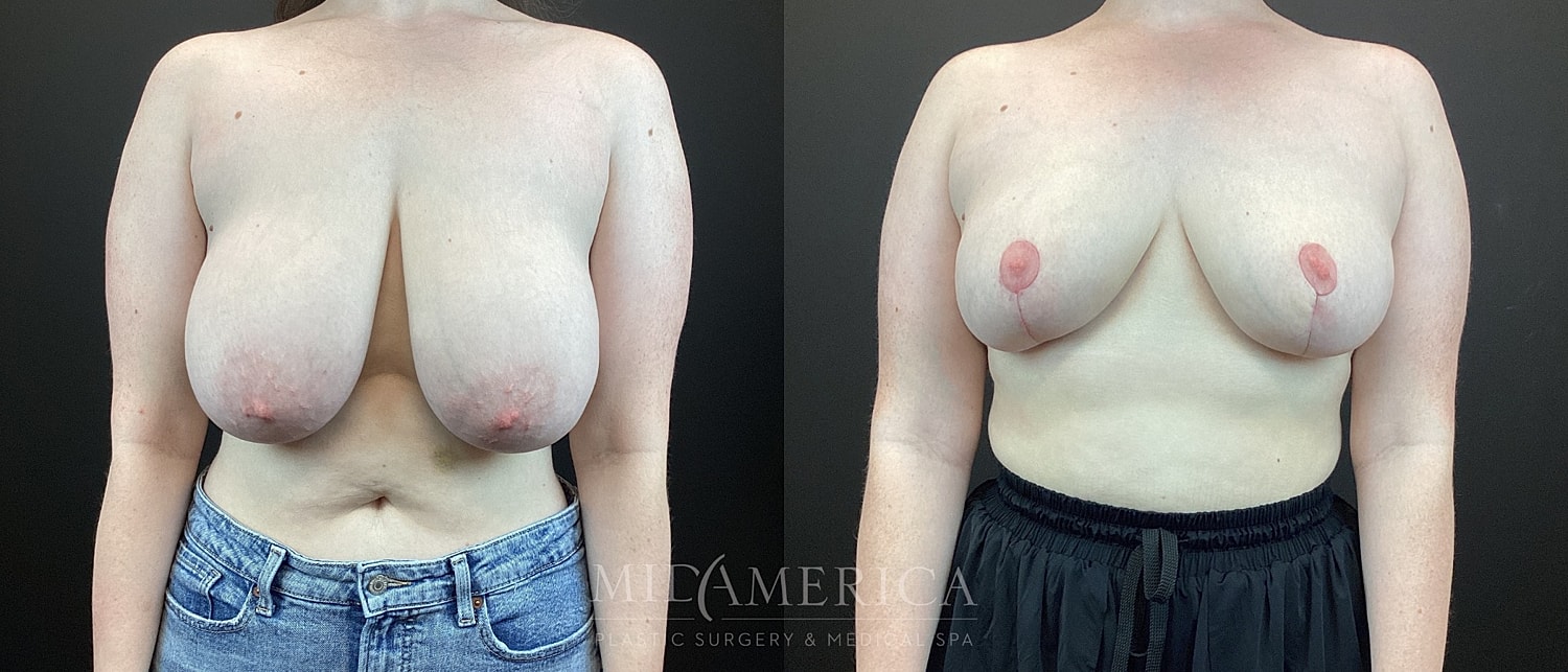 Breast Reduction Before & After