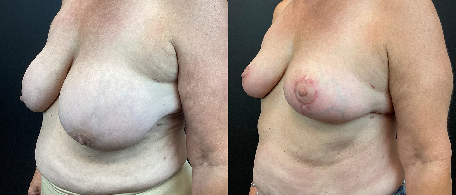 Breast Reduction Before & After