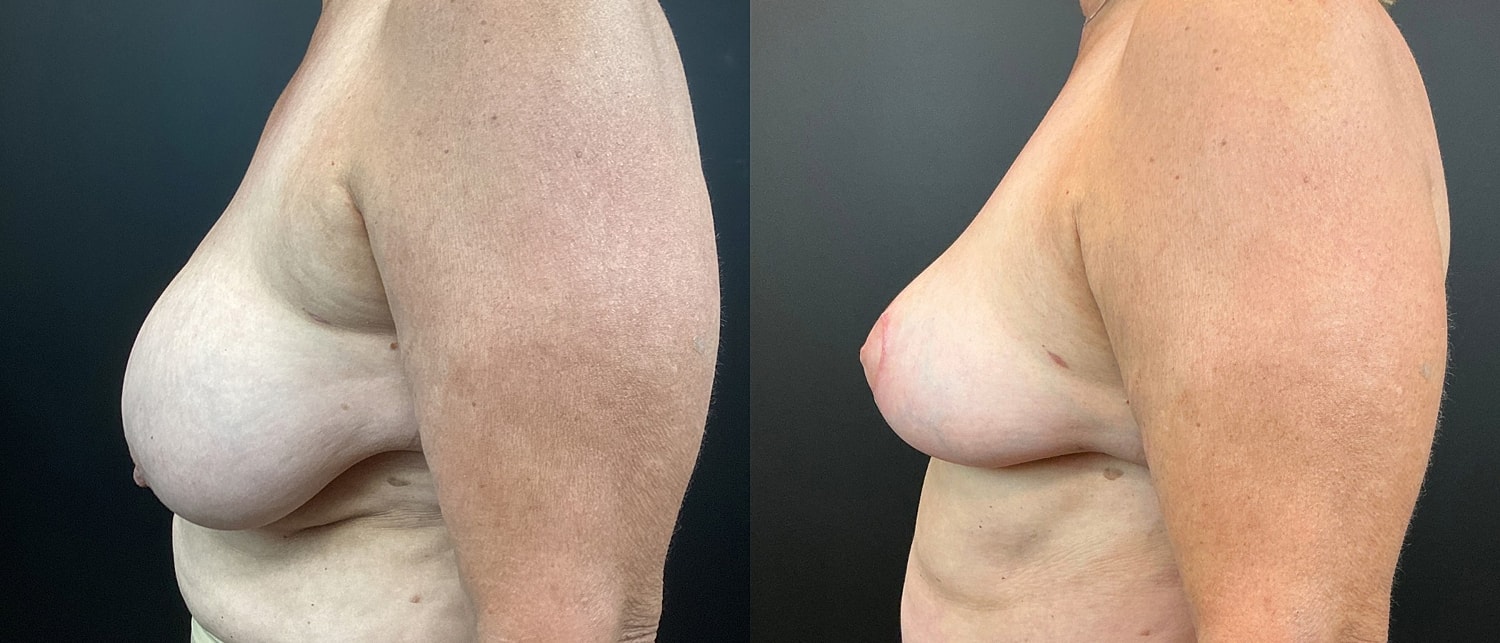 Breast Reduction Before & After