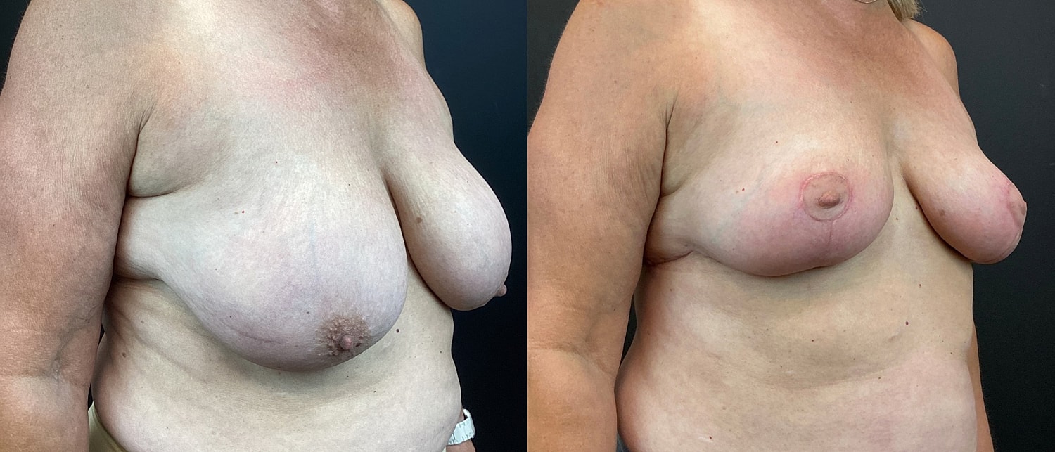 Breast Reduction Before & After