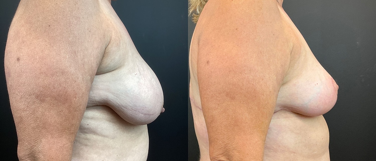 Breast Reduction Before & After