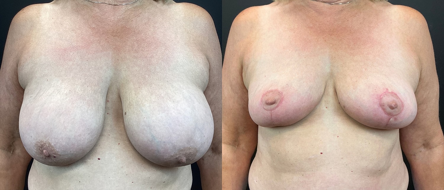 Breast Reduction Before & After