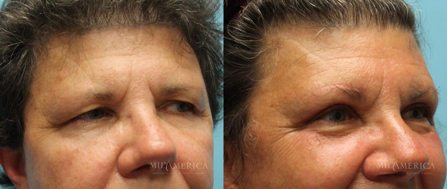 Eyelid Surgery Before & After