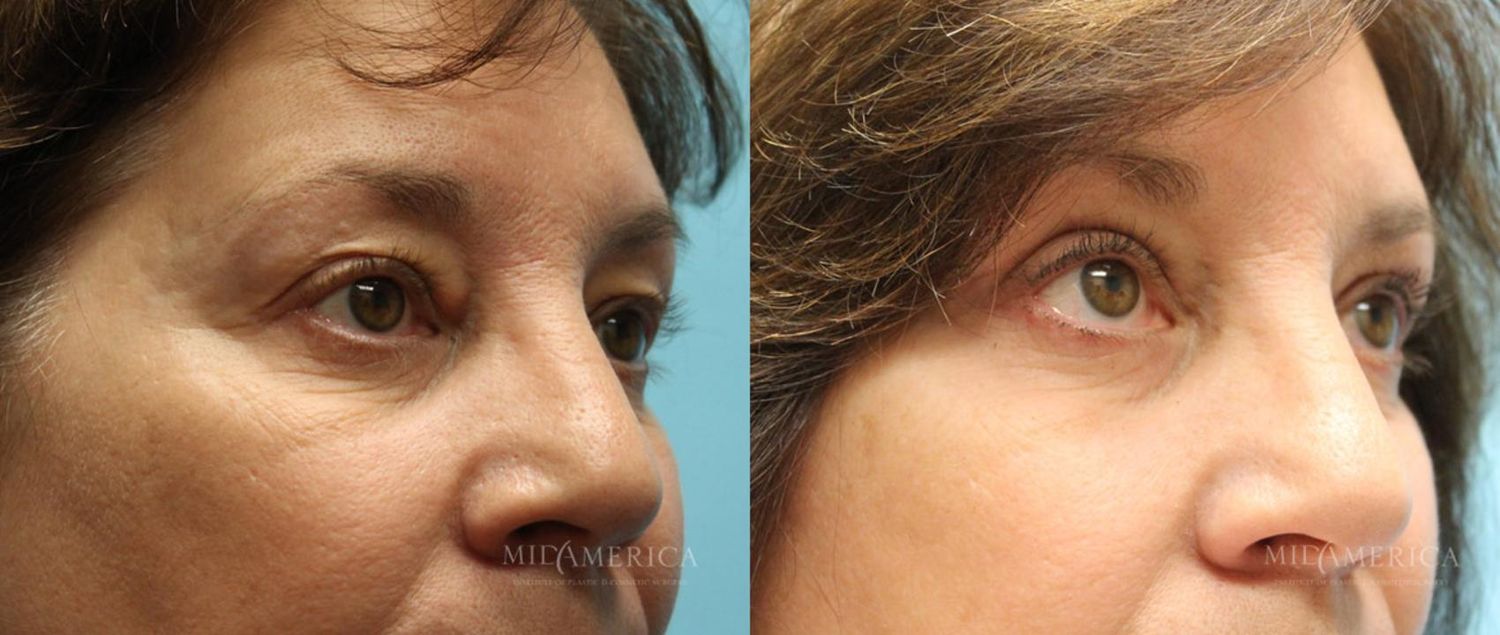 Eyelid Surgery Before & After