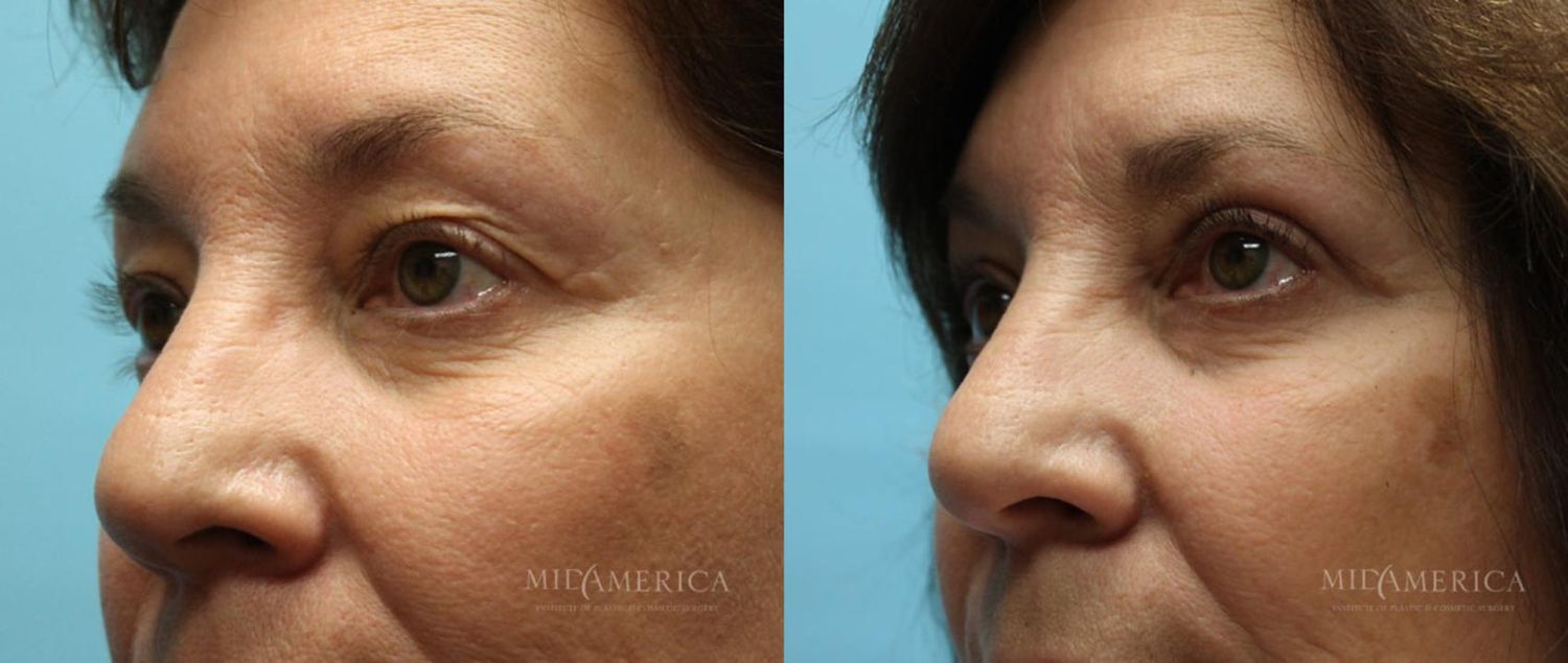 Eyelid Surgery Before & After