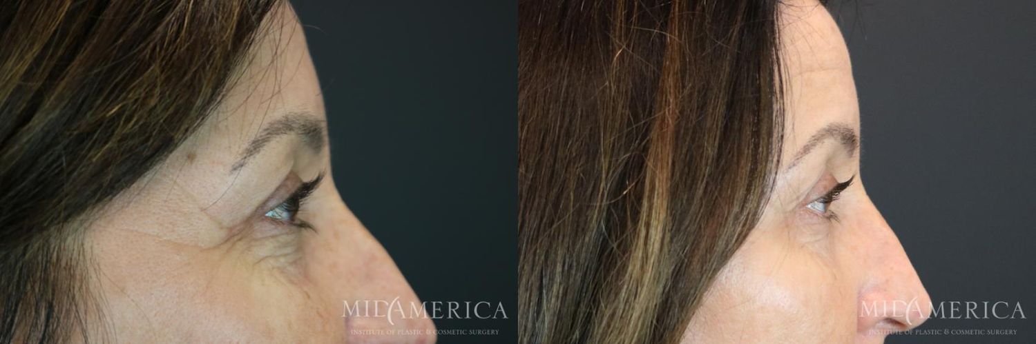 Eyelid Surgery Before & After